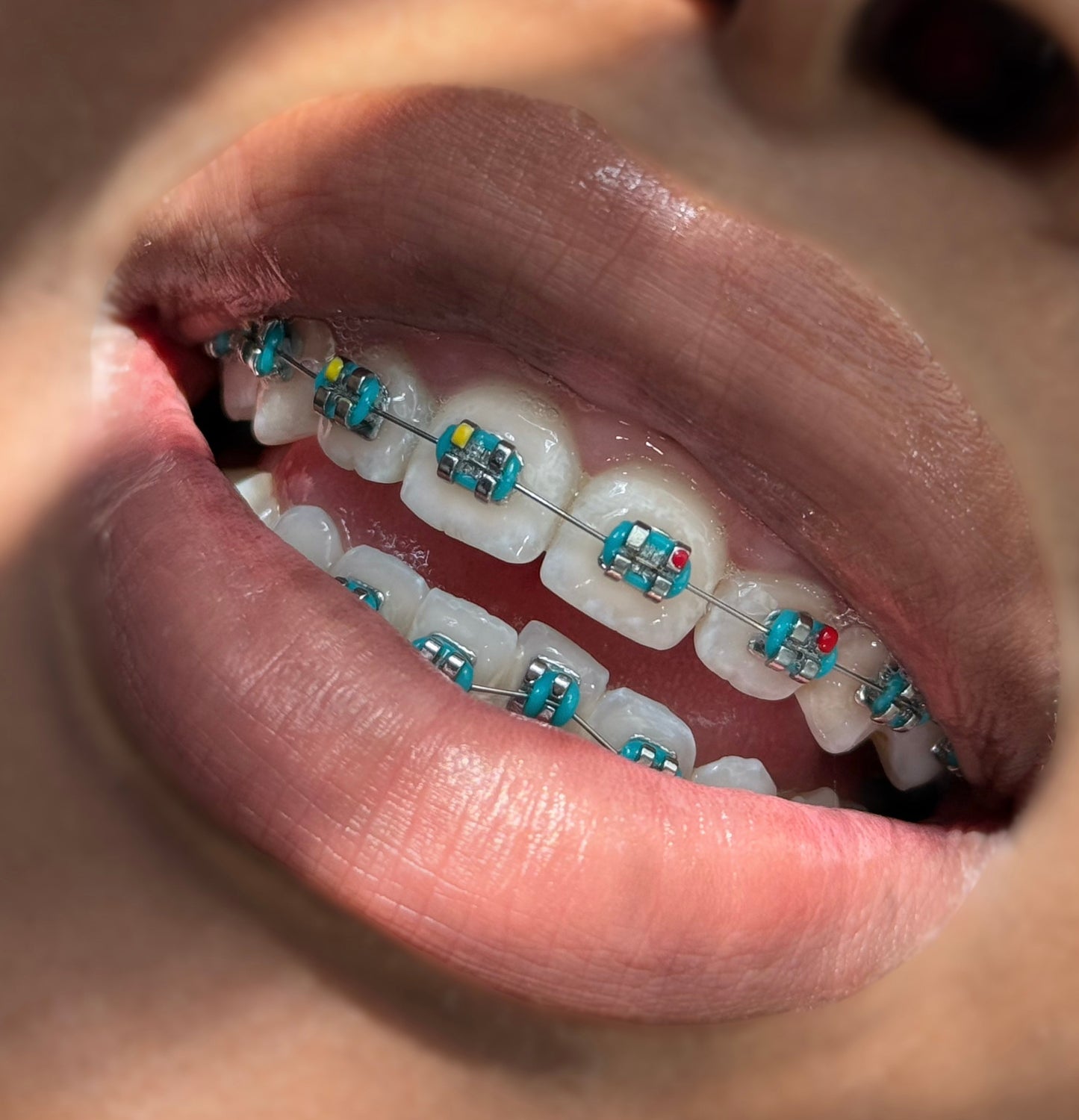 Braces Color Change Kit