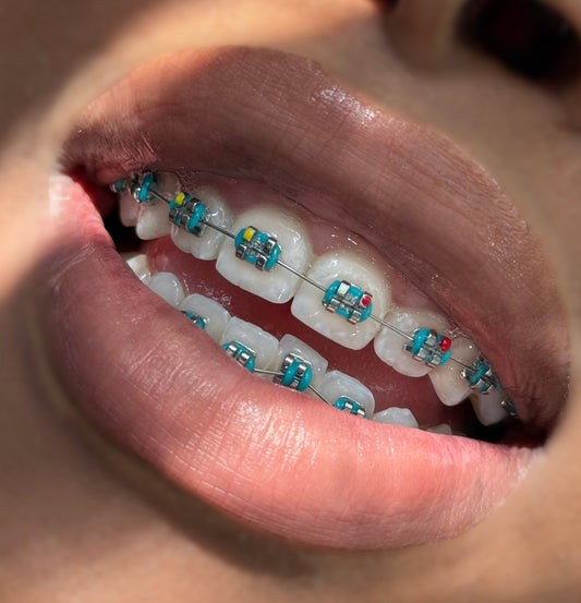Braces Color Change Kit